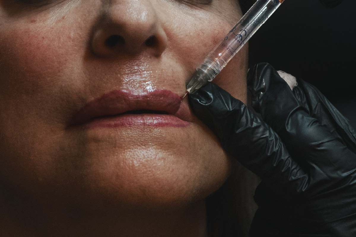 Detalle Relleno de labios