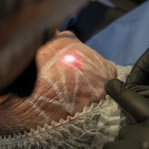 imagen de referencia de tratamiento de lifting facial